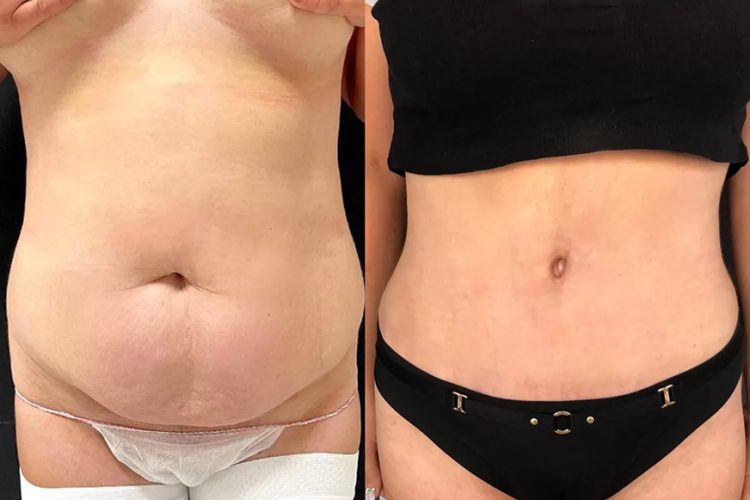 Послеродовый диастаз: причины появления и способы избавления