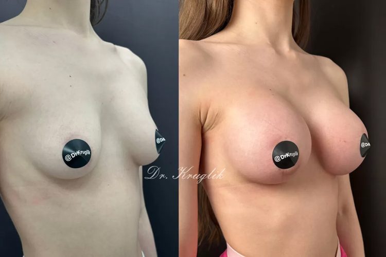 Как сделать грудь выше: путь к гармоничному силуэту