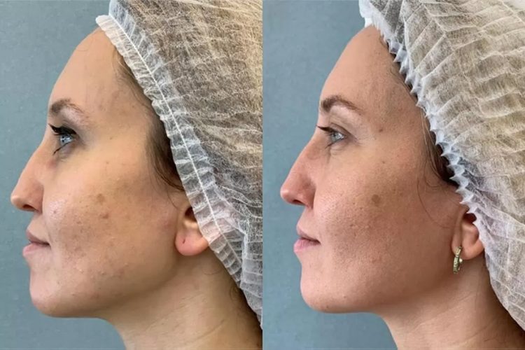 Увлажнение кожи лица: биоревитализация для сияния